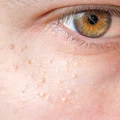 Masz na skórze białe krostki? Miej tego świadomość
