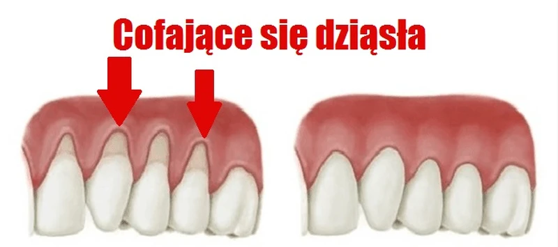 Sprawdź jak rozwiązać problem ODSUNIĘTYCH DZIĄSEŁ!