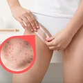 Żegnajcie czerwone kropki po goleniu bikini! Najlepsze preparaty i sposoby, które musisz znać!