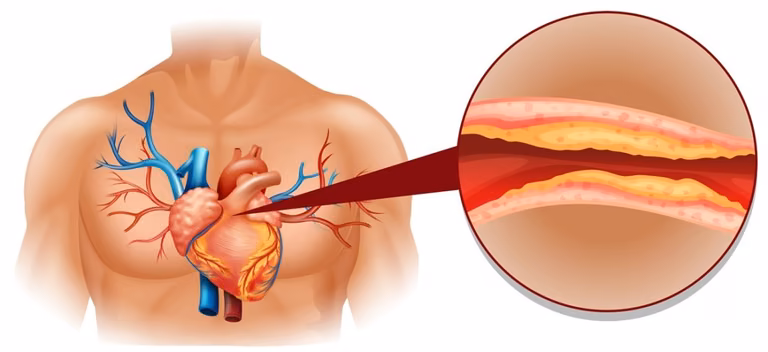 Sprawdź metody na OBNIŻENIE CHOLESTEROLU!