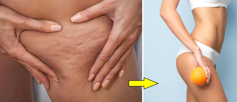 Masz cellulit? Nie jesteś na niego skazana! Sprawdź, jak z nim walczyć