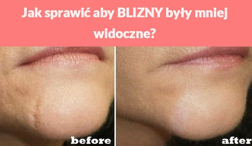 Jak sprawić aby BLIZNY były mniej widoczne?