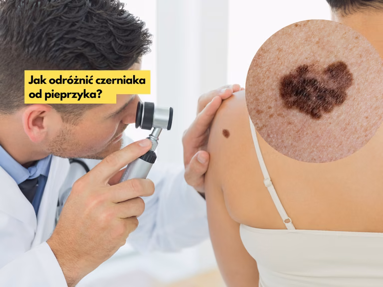 Jak odróżnić pieprzyk od czerniaka?
