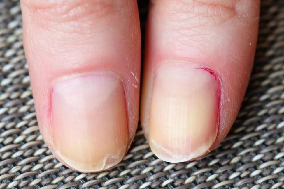 Zmiany na paznokciach, których nie należy lekceważyć! Co oznaczają poszczególne z nich?