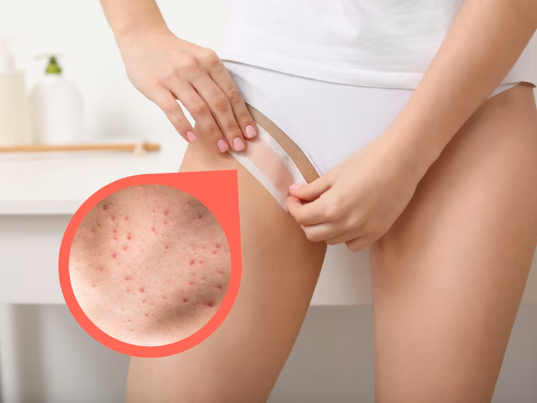 Żegnajcie czerwone kropki po goleniu bikini! Najlepsze preparaty i sposoby, które musisz znać!