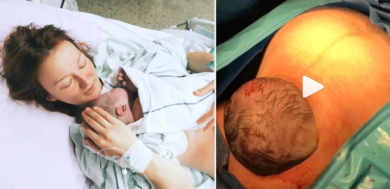 NOWY SPOSÓB RODZENIA - “Naturalne cesarskie cięcie”! Na czym polega?