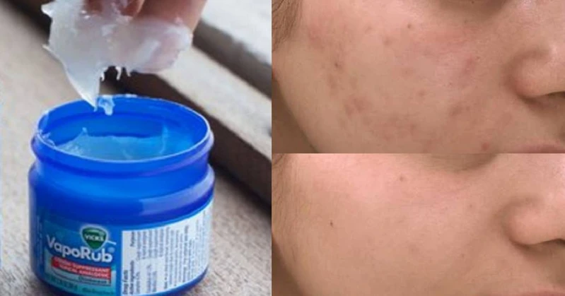 Vicks – genialne zastosowania miętowej maści, o których nie miałeś pojęcia!
