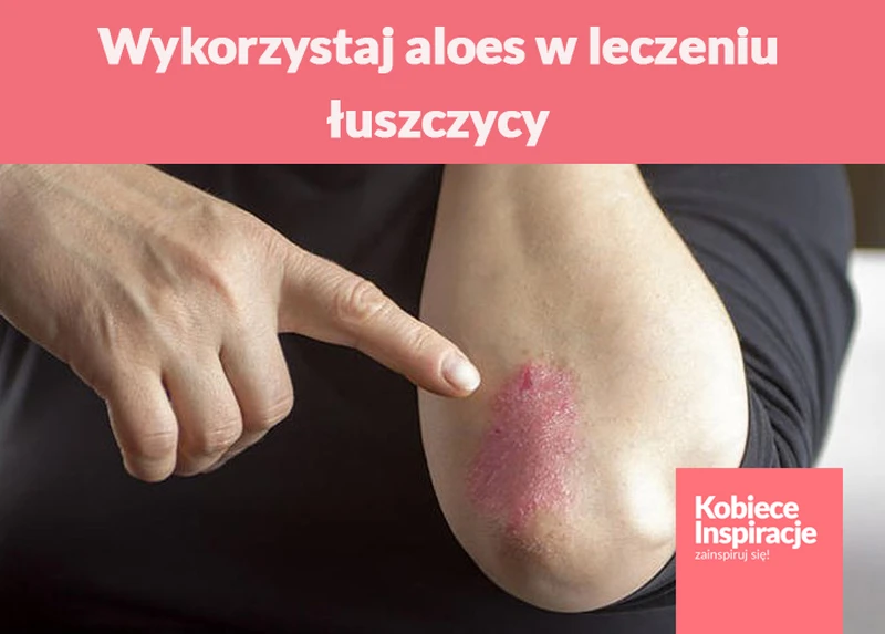 Wykorzystaj aloes w leczeniu łuszczycy