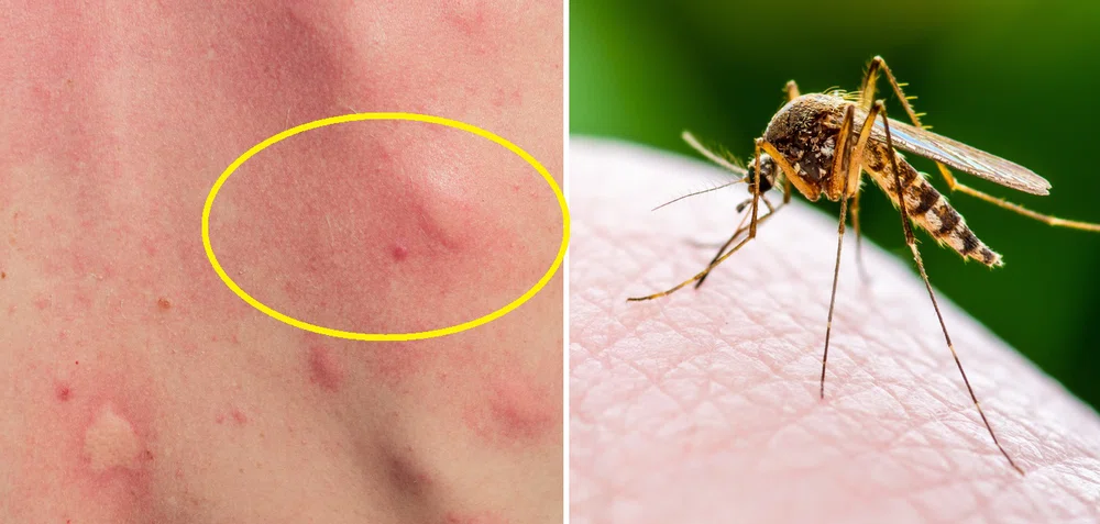 Dlaczego komary niektórych gryzą częściej?  Znamy powód i NIE JEST to “słodka krew”