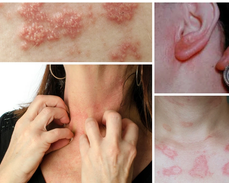 Alergia na biżuterię i ubrania?! Nie bądź zaskoczona!