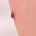 Zaskakujące preferencje kleszczy! Te miejsca Twojego ciała są najbardziej podatne na ich atak!