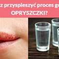 Chcesz przyspieszyć proces gojenia OPRYSZCZKI?