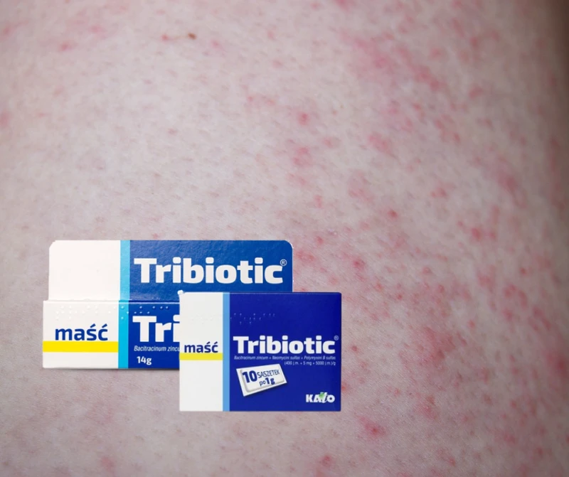 TRIBIOTIC - maść za około 2 złote, która potrafi zdziałać cuda!