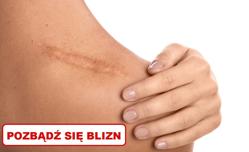 Pozbądź się BLIZN naturalnym sposobem!