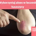 Wykorzystaj aloes w leczeniu łuszczycy