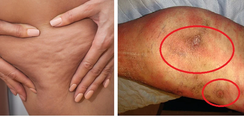 Czy wiesz, że cellulit i cellulitis to dwie zupełnie różne rzeczy? Poznaj różnice