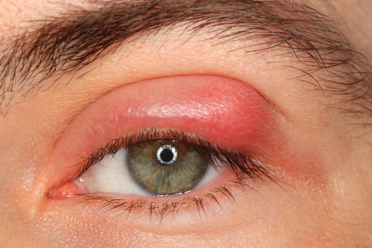 Jęczmień na oku – 5 sposobów na jego usunięcie