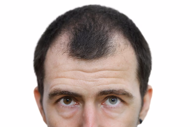 Jak zapobiec łysieniu?