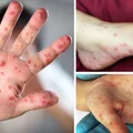 Bostonka – groźna choroba dotykająca małe dzieci. Poznaj jej przyczyny i objawy
