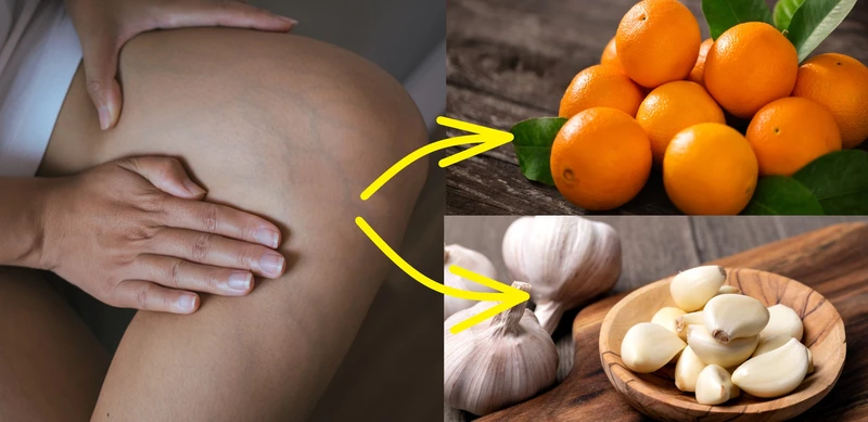 Masz problem z żylakami? Możesz je usunąć dzięki temu domowemu sposobowi!