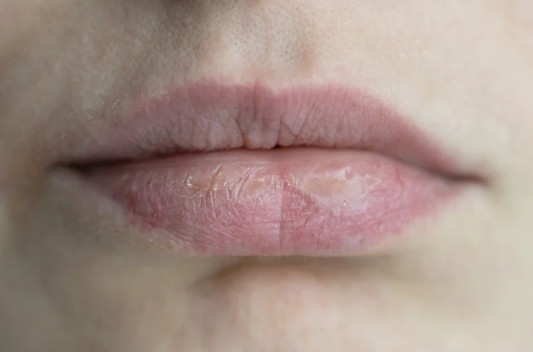 Zdjęcie Twoje usta są suche i spierzchnięte? To może być sygnał ostrzegawczy organizmu! Nie ignoruj go! #1