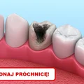 Zobacz jak samemu zwalczyć PRÓCHNICĘ!