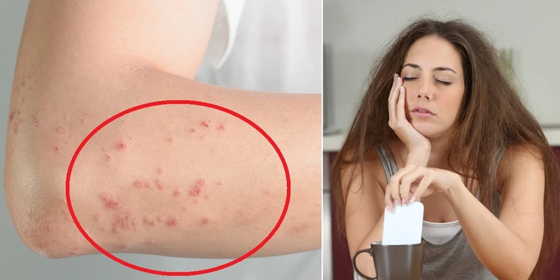 Masz te objawy? To może być alergia. Sprawdź, na co możesz być uczulony