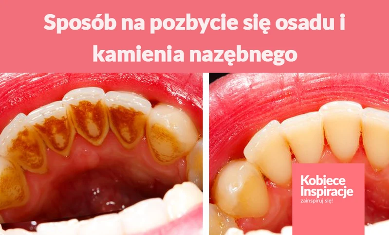 Prosty sposób na pozbycie się osadu i kamienia nazębnego.