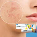 Hit z apteki za 18 zł na przebarwienia i tłustą cerę! Zaskakujące właściwości Acne-derm!