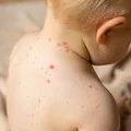Ospa wietrzna u dzieci- co warto wiedzieć?