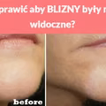 Jak sprawić aby BLIZNY były mniej widoczne?