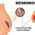 Zobacz jak leczyć HEMOROIDY i jak do nich nie dopuścić