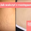 Jak walczyć z rozstępami? Pomoże Ci w tym kawa i oliwa z oliwek