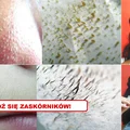 Poznaj 2 najlepsze sposoby na ZASKÓRNIKI