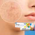 Hit z apteki za 18 zł na przebarwienia i tłustą cerę! Zaskakujące właściwości Acne-derm!