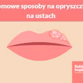 Domowe sposoby na opryszczkę na ustach - 5 SPRAWDZONYCH METOD