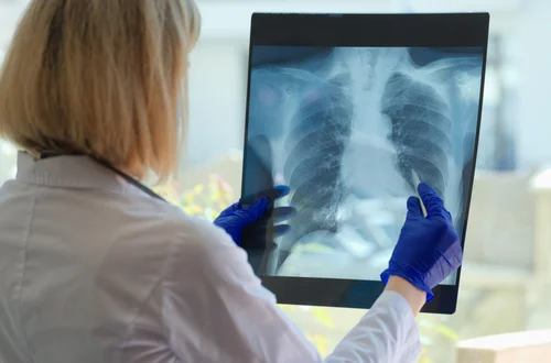 Światowy Dzień Gruźlicy: Walka z Jedną z Najstarszych Chorób Zakaźnych