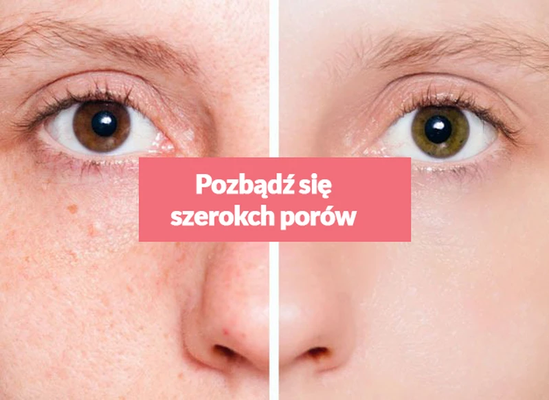 Pozbądź się szerokich porów za pomocą kilku domowych składników!