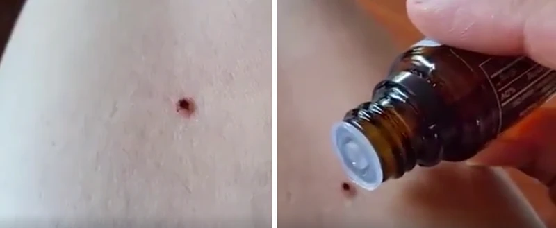 Usuwanie KLESZCZA przy pomocy OLEJKU MIĘTOWEGO? Lepiej tego nie rób!