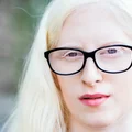 Międzynarodowy Dzień Świadomości nt. Albinizmu: Zrozumieć i Wspierać