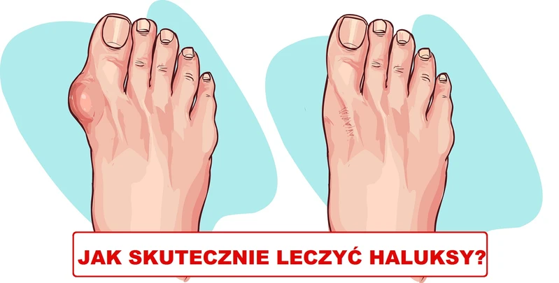 Masz HALUKSY? Sprawdź jak sobie z nimi radzić!