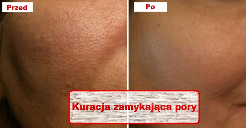 Wypróbuj kurację która zniweluje otwarte PORY