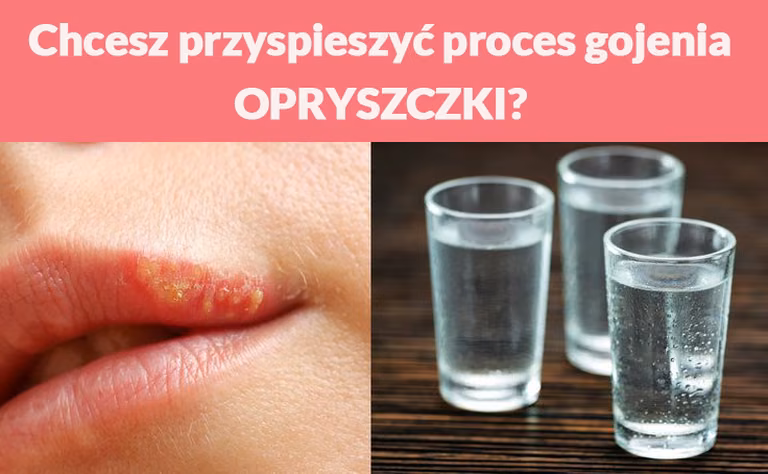 Chcesz przyspieszyć proces gojenia OPRYSZCZKI?