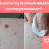 Jak pozbyć się brodawek miękkich domowym sposobem?
