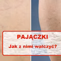 Zauważyłaś na swoim ciele tzw PAJĄCZKI? Pozbądź się ich domowym sposobem