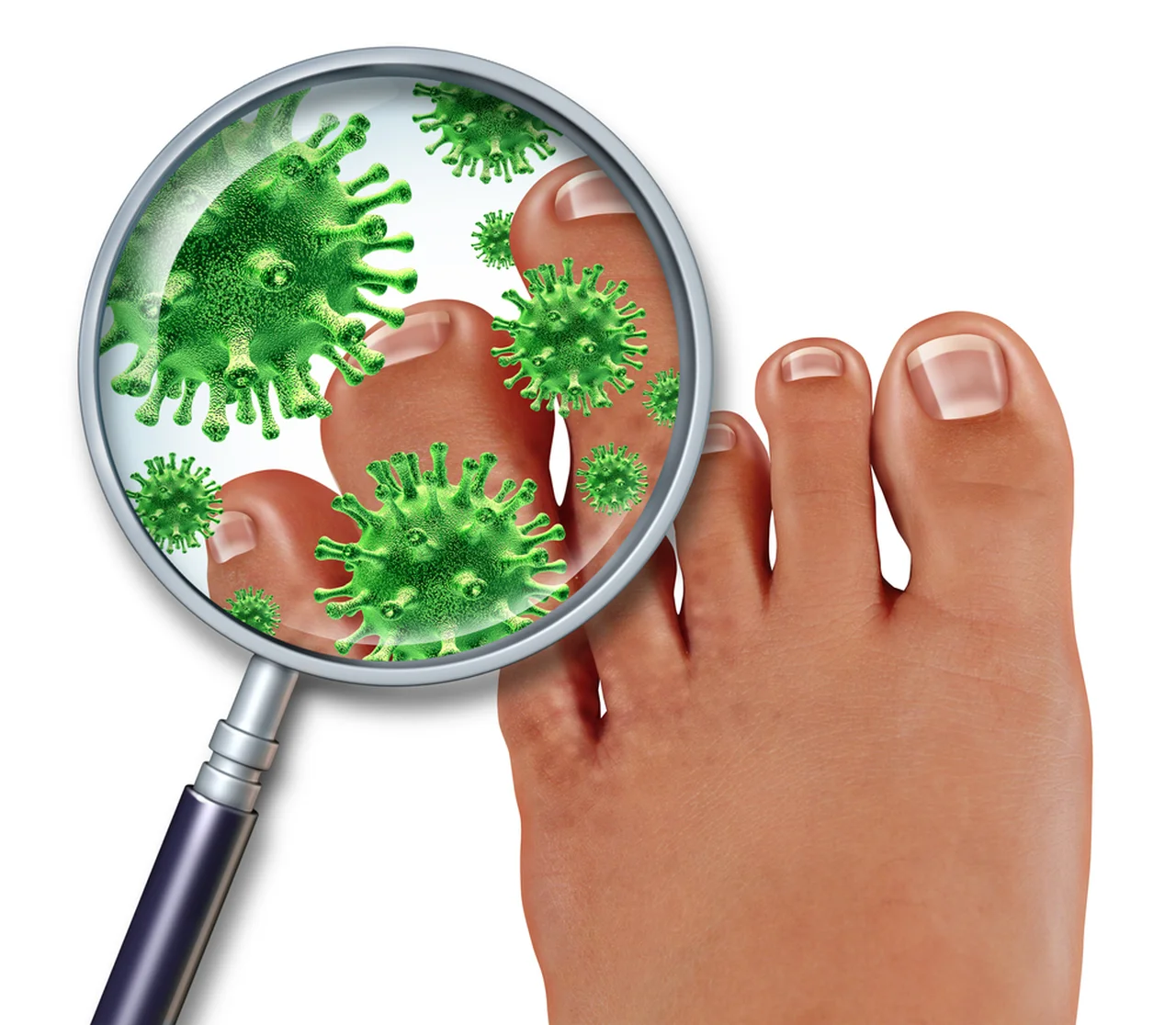 2 rodzaje grzybicy stóp – jak rozpoznać symptomy choroby?