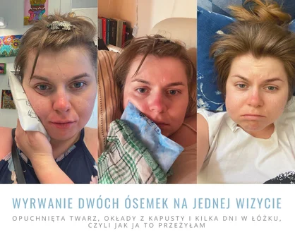 Wyrwanie dwóch ósemek na jednej wizycie - opuchnięta twarz, okłady z kapusty i kilka dni w łóżku