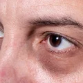 Dlaczego skóra wokół oczu jest podrażniona? Sprawdź możliwe przyczyny!