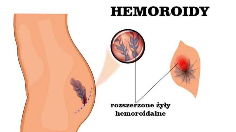 Zobacz jak leczyć HEMOROIDY i jak do nich nie dopuścić