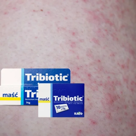 TRIBIOTIC - maść za około 2 złote, która potrafi zdziałać cuda!